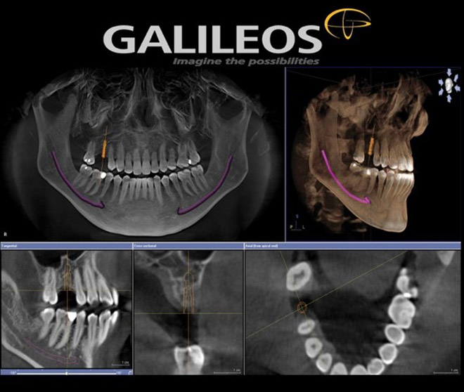 Cone beam 3d dentascanner Sousse